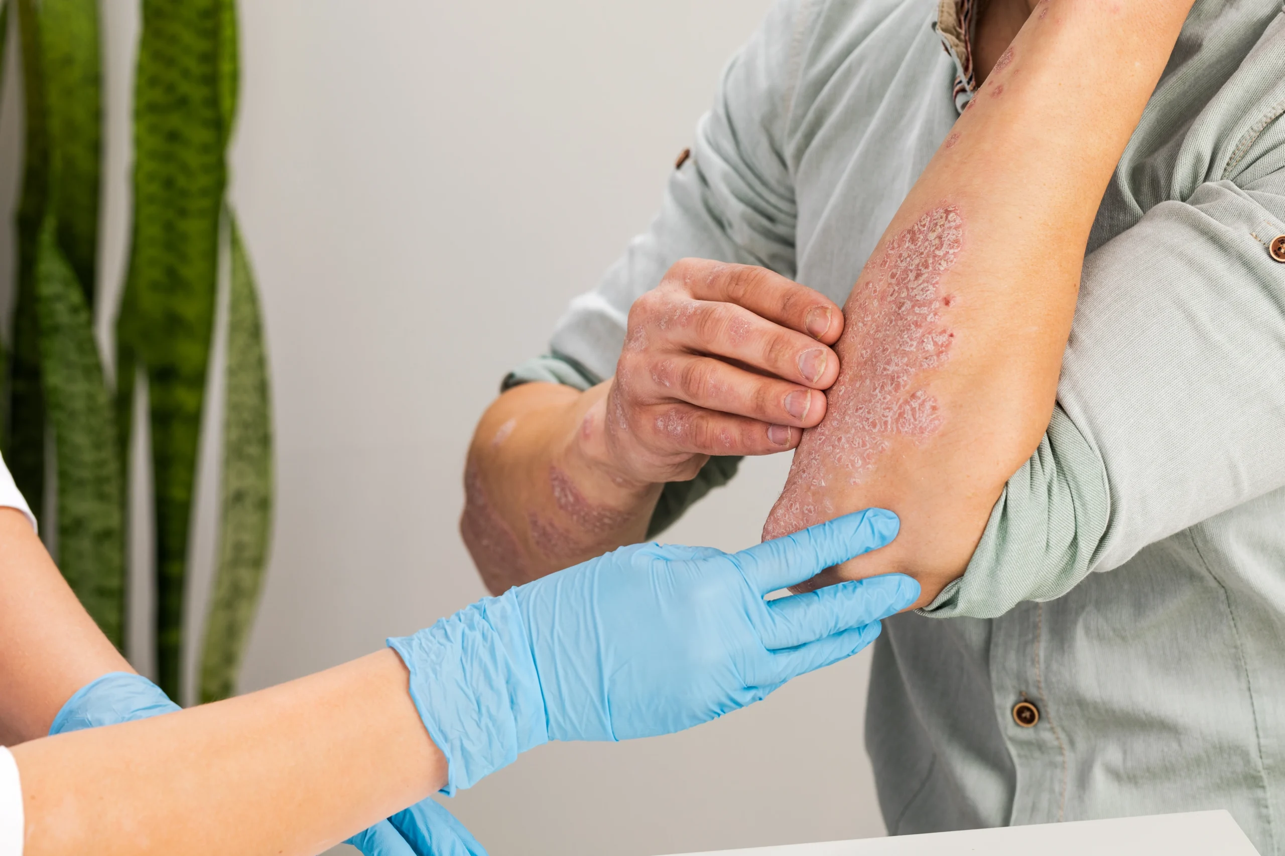 Biopharma companies Evommune and Nektar soar on eczema treatment data