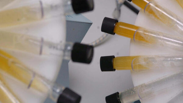 Cambridge researchers develop urine test that could detect lung cancer years earlier