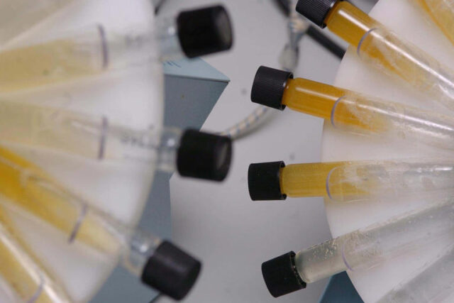Cambridge researchers develop urine test that could detect lung cancer ...
