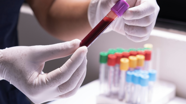 AI-powered blood test promises lung cancer detection years in advance