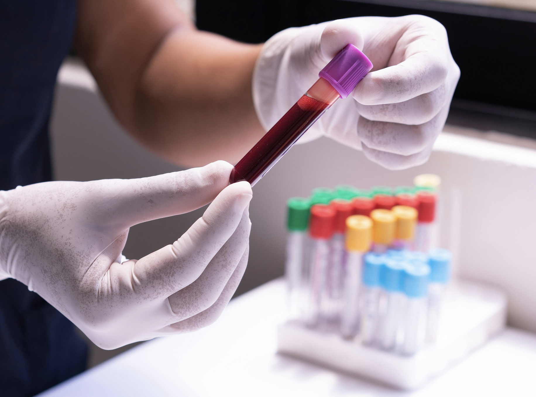 AI-powered blood test promises lung cancer detection years in advance