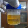 BioMark expands lung cancer screening portfolio with patented urine test