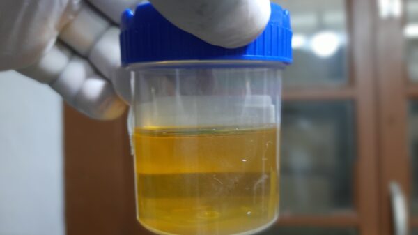BioMark expands lung cancer screening portfolio with patented urine test