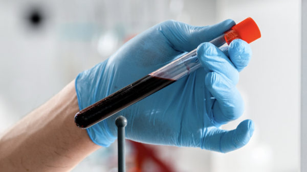 Liquid chromatography-mass spectrometry proves its worth in lung cancer screening
