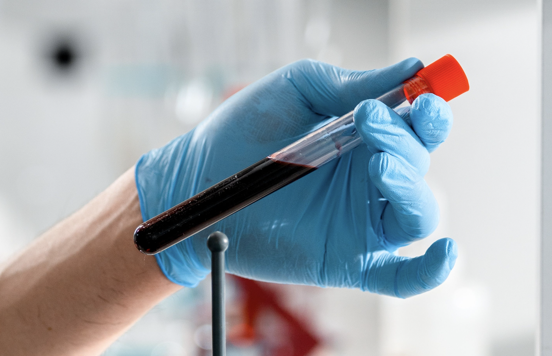 Liquid chromatography-mass spectrometry proves its worth in lung cancer screening