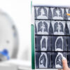 Lung cancer screening awareness remains low despite advances in early detection