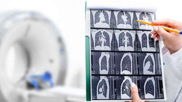 Lung cancer screening awareness remains low despite advances in early detection