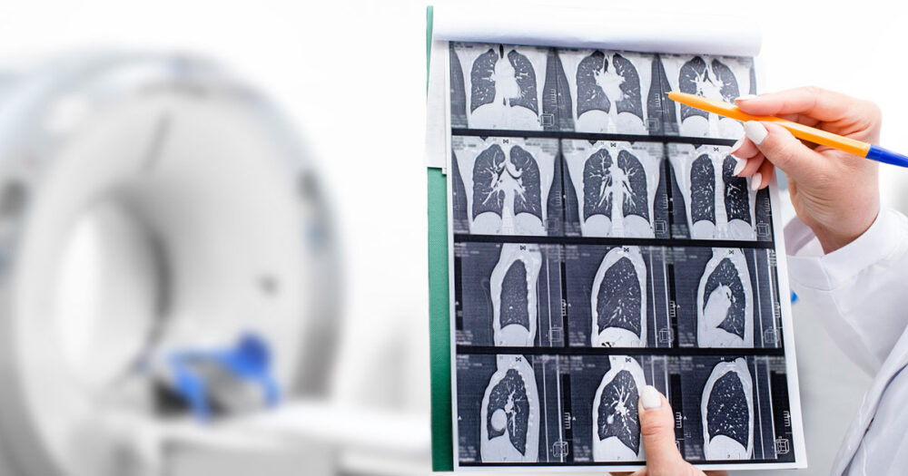 Lung cancer screening awareness remains low despite advances in early detection